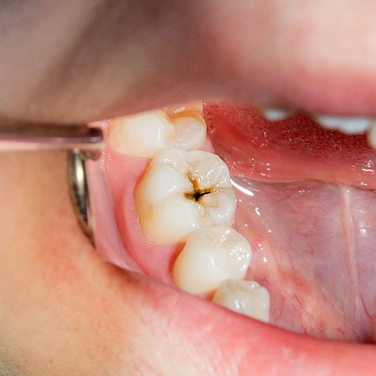 contagious cavities